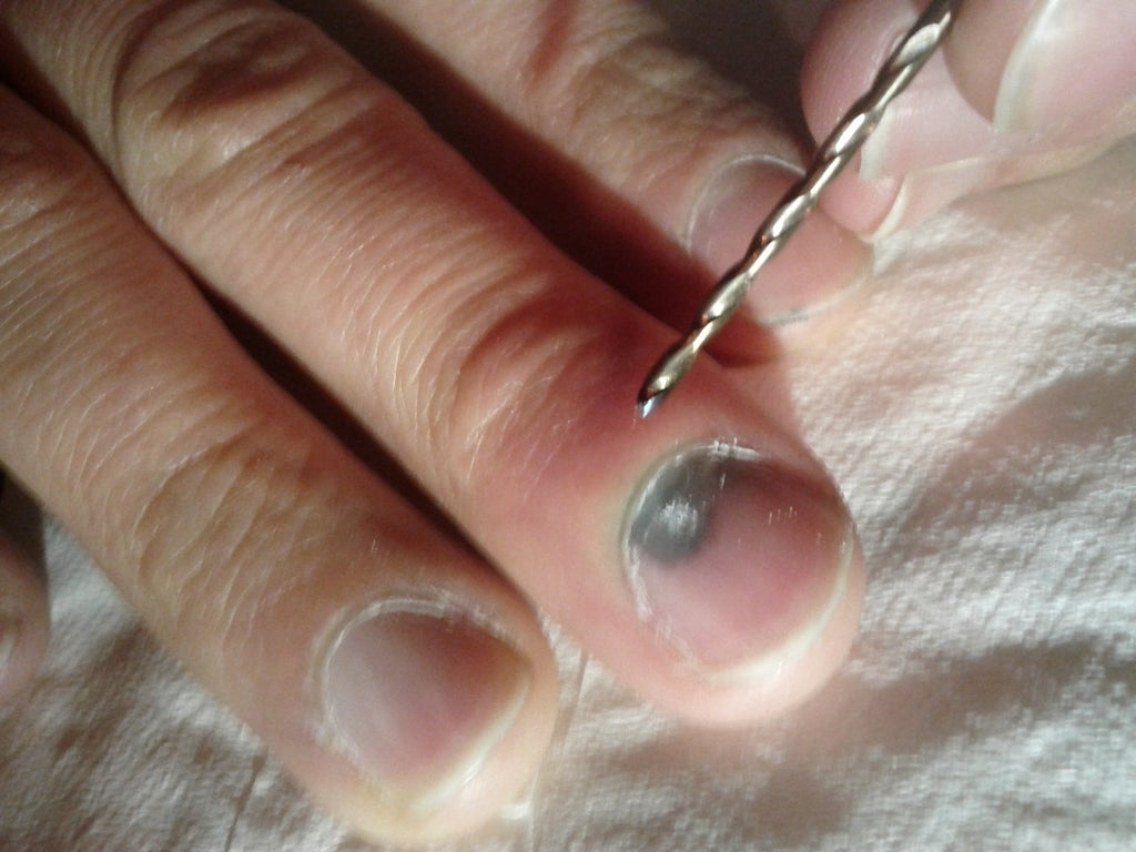 How To Drain Your Subungual Hematoma Blood Pocket Under Finger Nail With A Drill Bit 6 Steps With Pictures Instructables