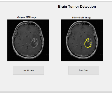 Brain Tumor MRI Detection Using Matlab : 6 Steps - Instructables
